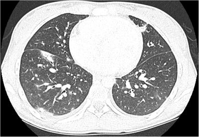 Case Report: MIS-C With Prominent Hepatic and Pancreatic Involvement in a Vaccinated Adolescent – A Critical Reasoning